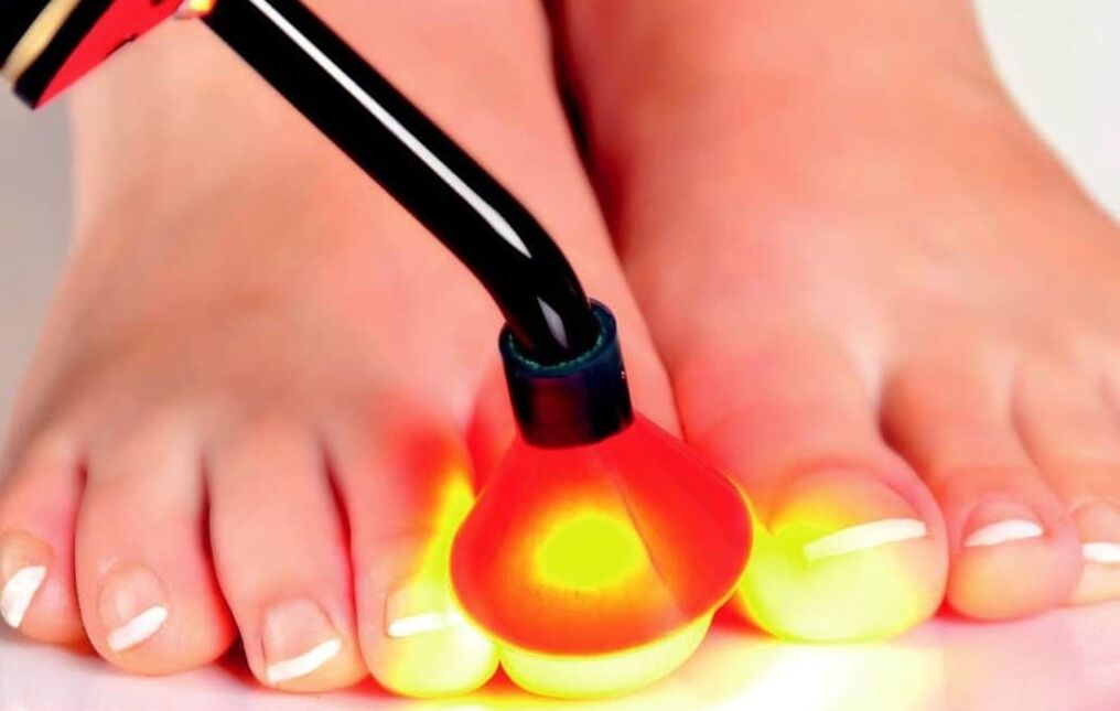 Tratamento a laser da placa de unha