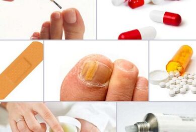Como tratar fungos nas unhas